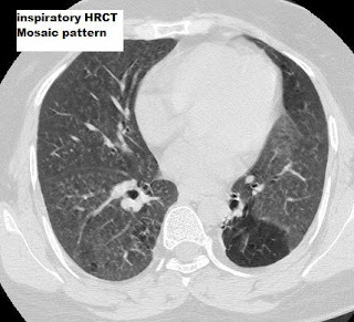 Small Airway Disease on Dynamic HRCT - Sumer's Radiology Blog